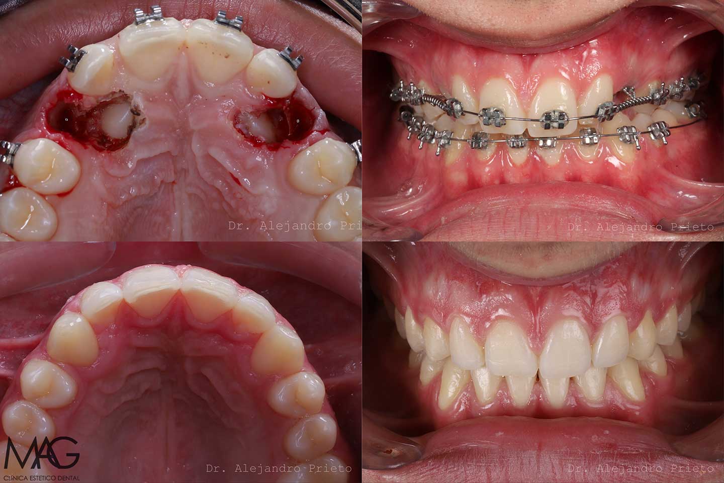 dientes incrustados en la enc&iacute;a