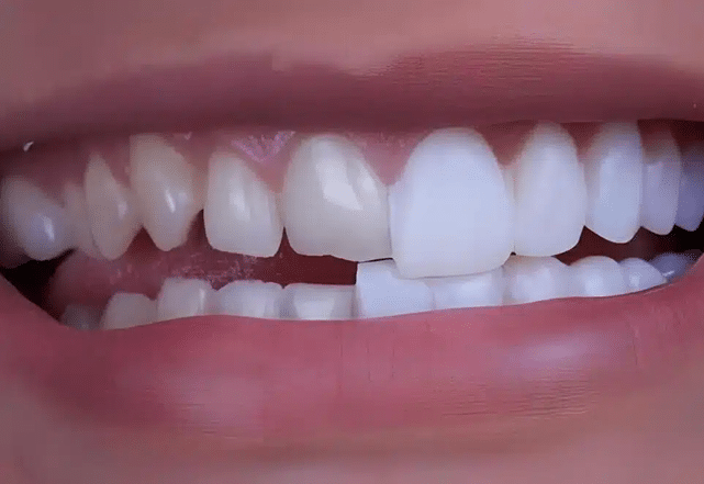 fotos de tipos de carillas y foto de carillas de composite