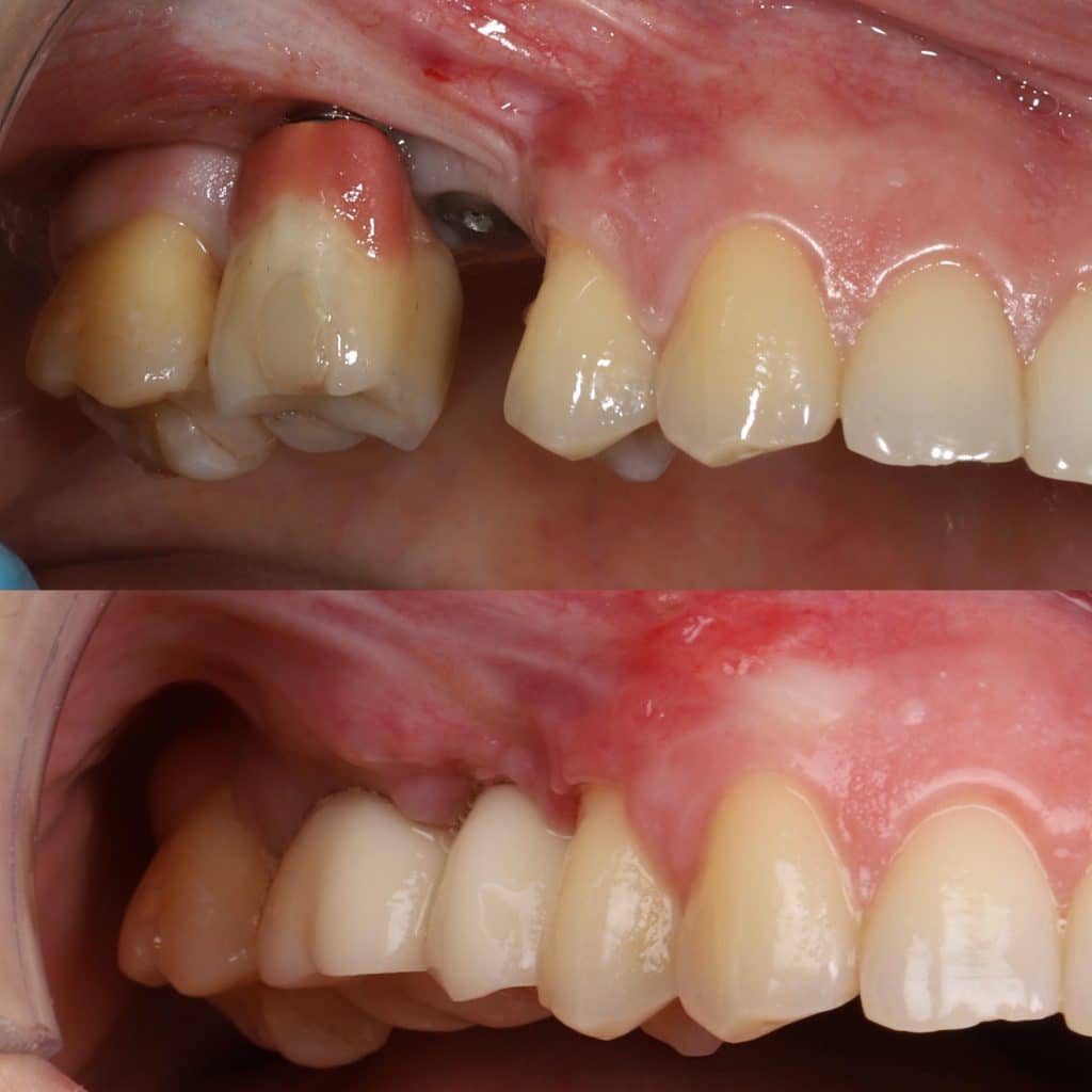 foto de implantes mal colocados periimplantitis