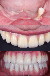 Caso antes y después de colocar implantes cigomáticos