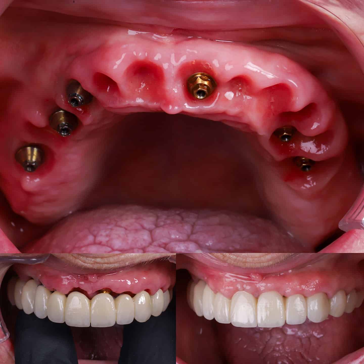 ejemplo de implantes All on 6 para rehabilitar arcada completa con prótesis fija