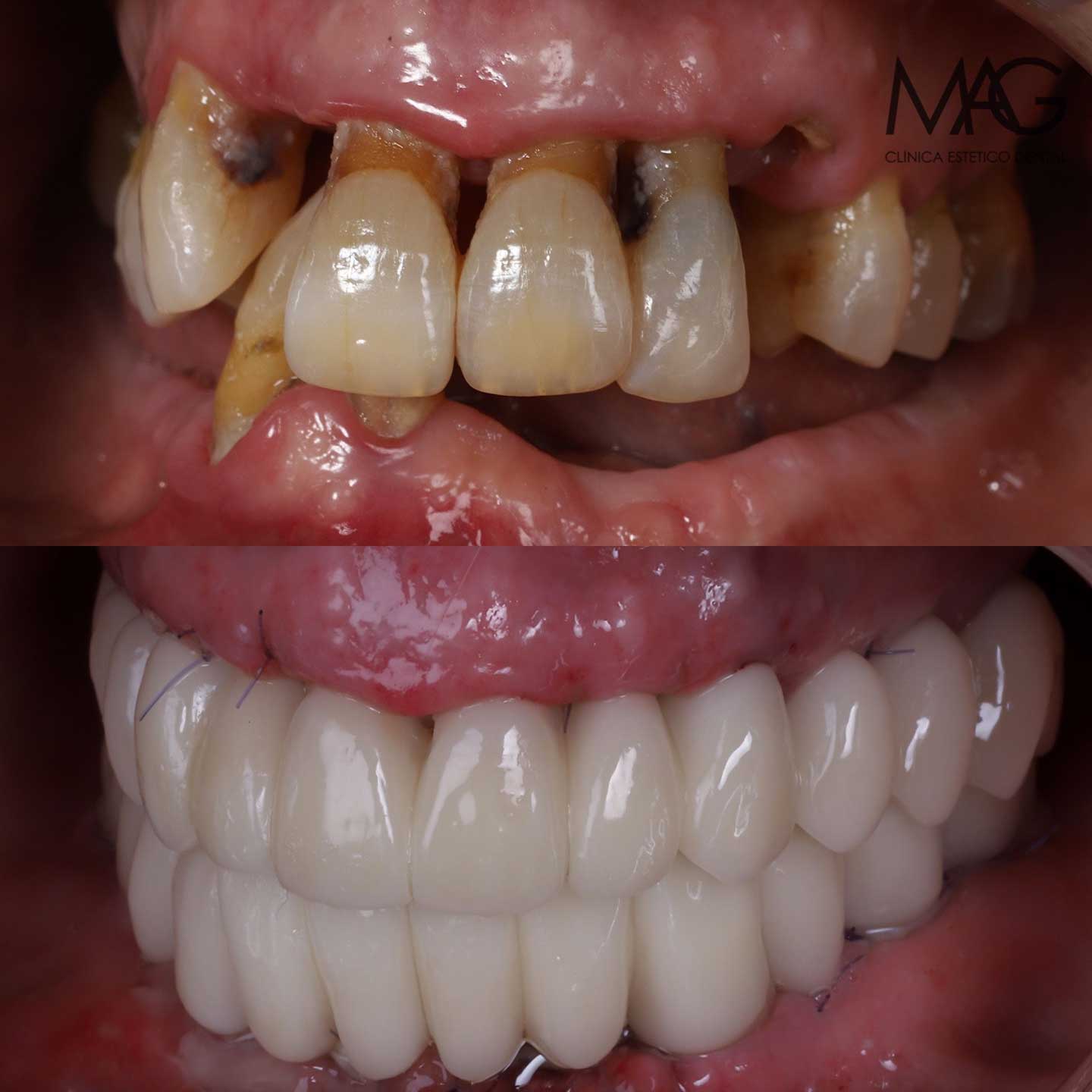 enfermedad periodontal avanzada, piorrea. Fotos de antes y despu&eacute;s