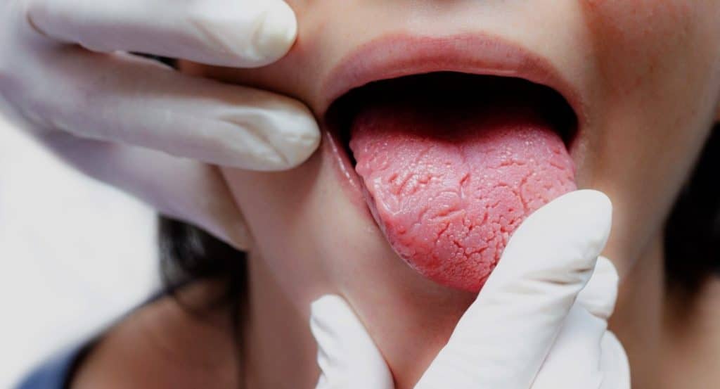 Lengua con cambios en su color o textura, indicando una posible afección.