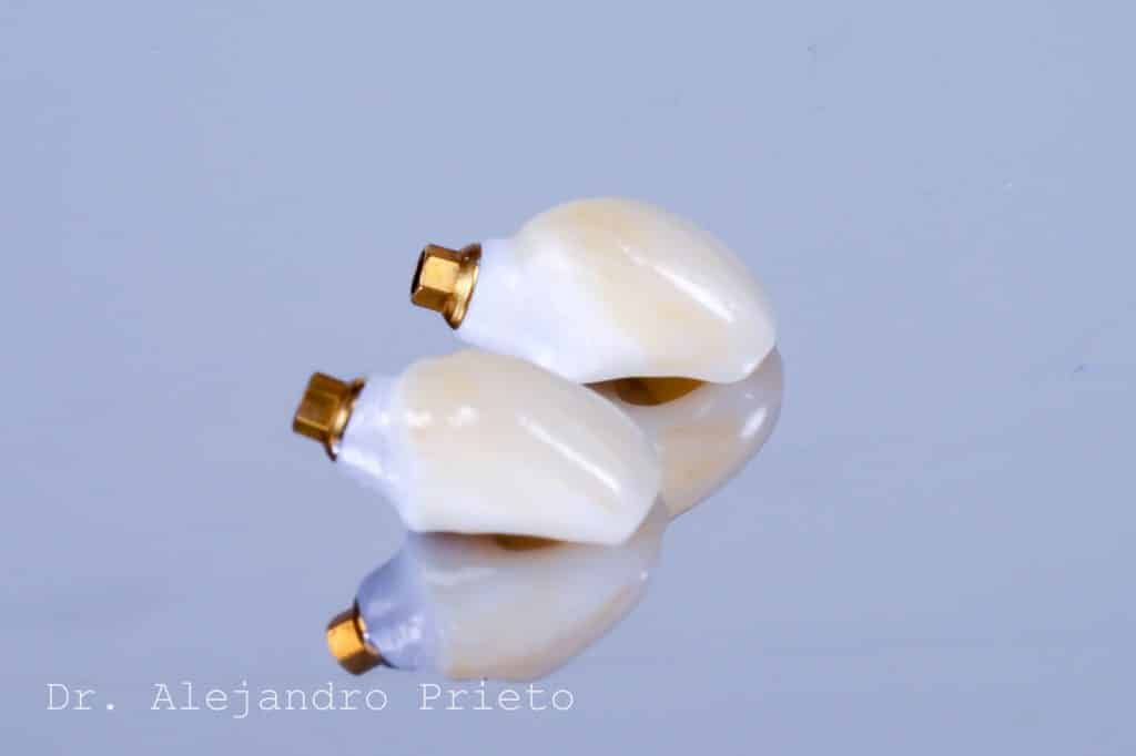 foto de corona o prótesis dental para precio de implante dental completo