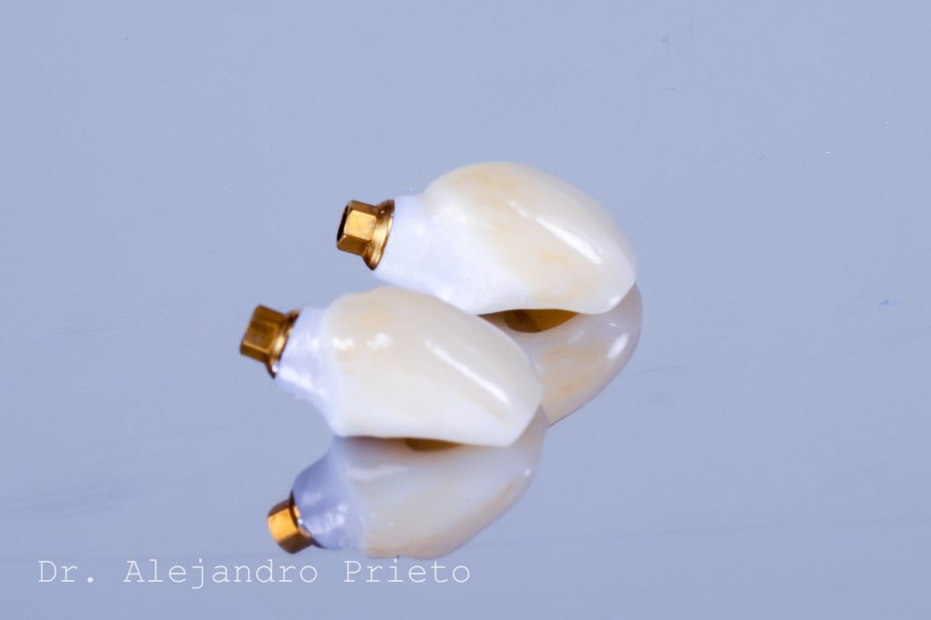 foto de las 10 mejores marcas de implantes dentales