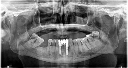 Ejemplo de antes y después de la colocación de los implantes cigomáticos