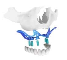 Implantes dentales yuxta-óseos
