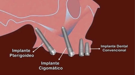 Ejemplo de implantes pterigoideos y cigomáticos