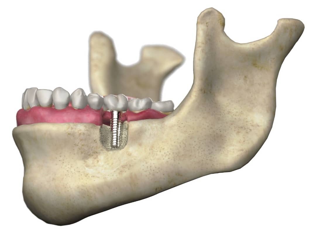 Foto del proceso de integración de implante en el hueso, también conocido como proceso de osteointegración del implante dental en el hueso maxilar