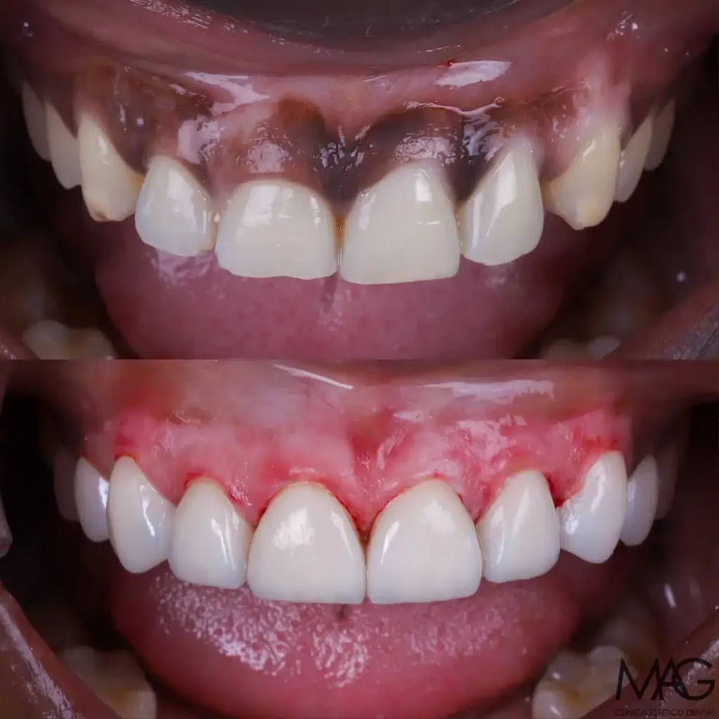 tratamiento peeling enc&iacute;as negras antes y despu&eacute;s