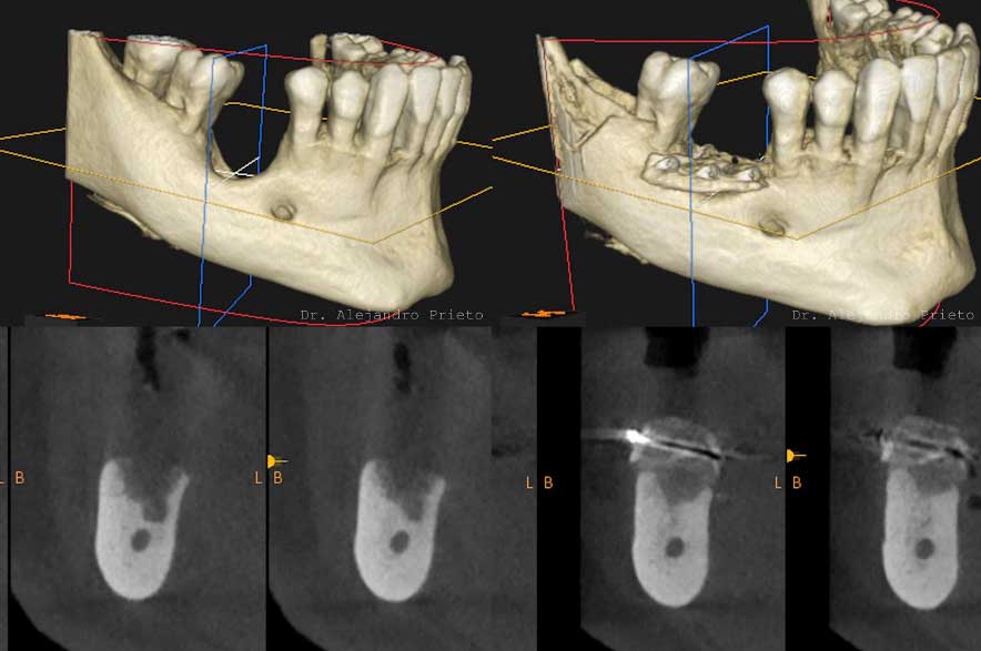Radiograf&iacute;a de antes y despu&eacute;s en paciente con poco hueso