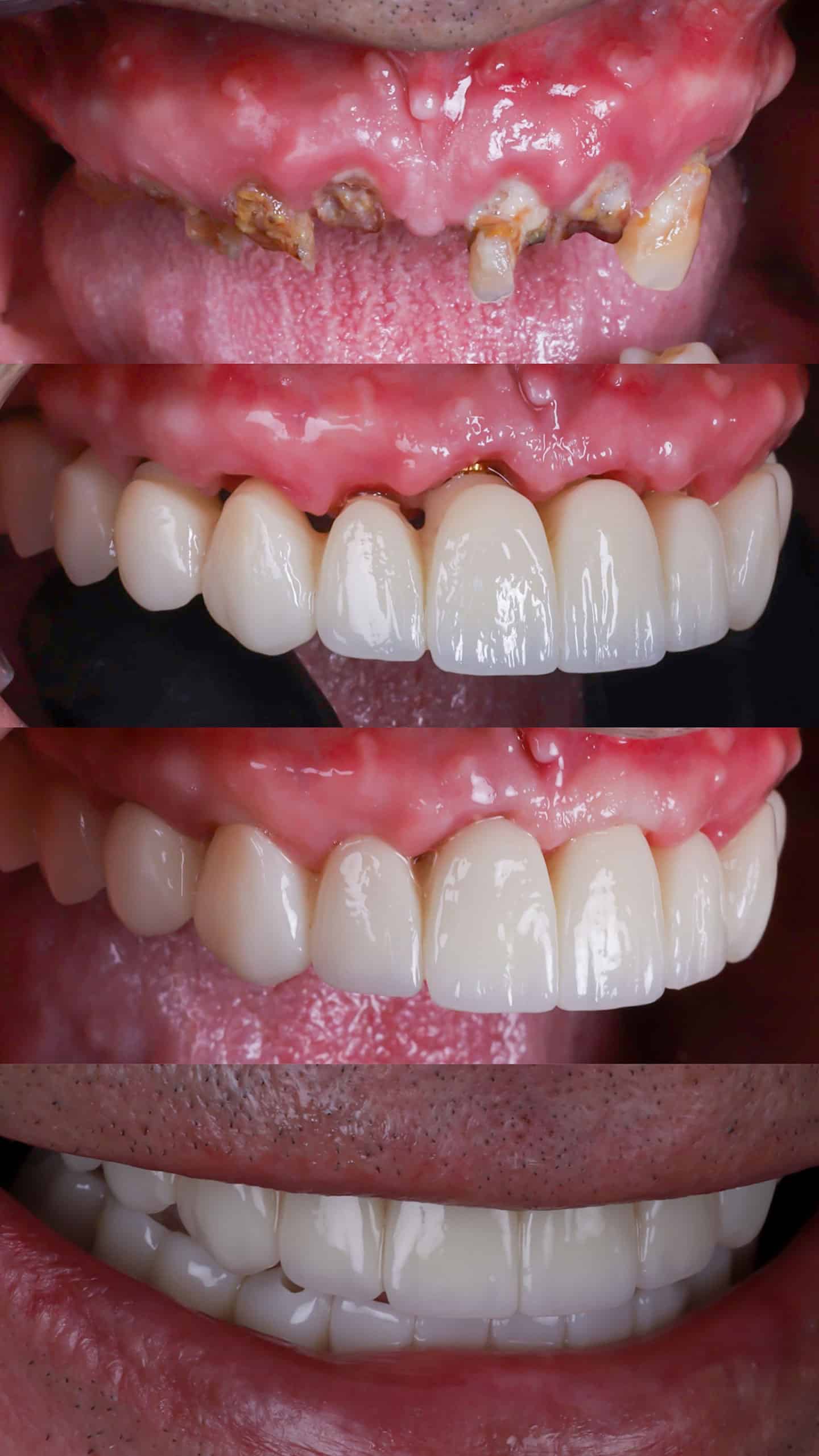 rehabilitación arcada superior con implantes