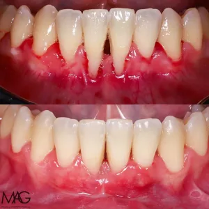 caso de injerto de enc&iacute;a antes y despu&eacute;s