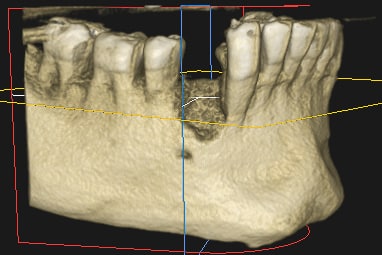 regeneración hueso para implante dental
