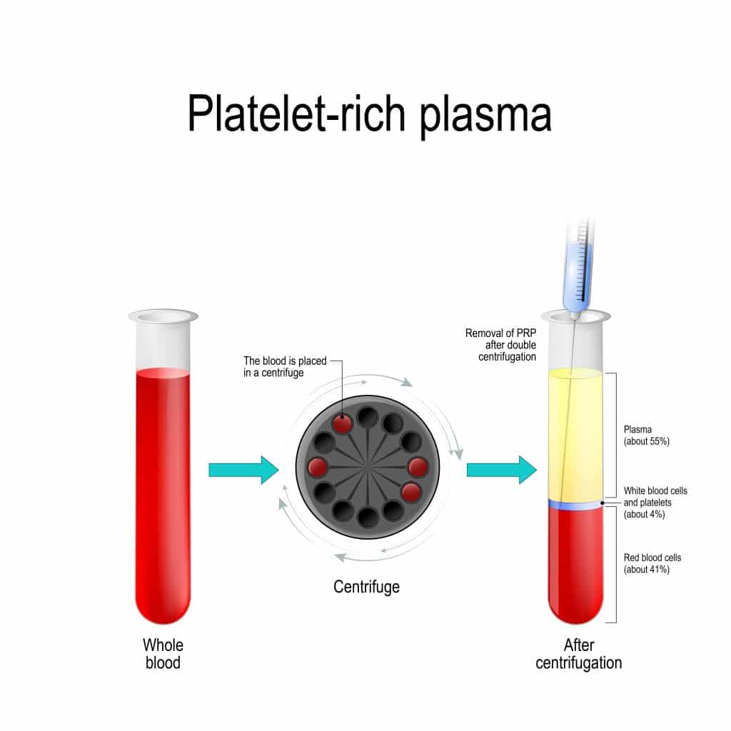 plasma rico en plaquetas para regeneraci&oacute;n de hueso para implantes dentales