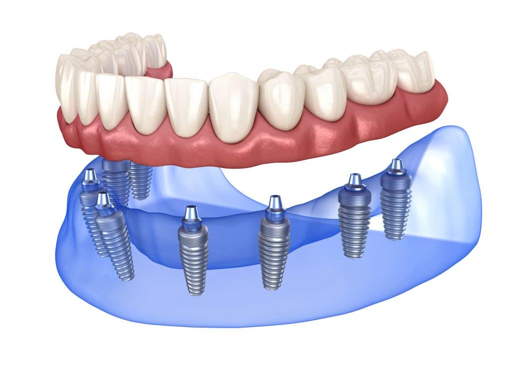 foto prótesis fija sobre implantes dentales
