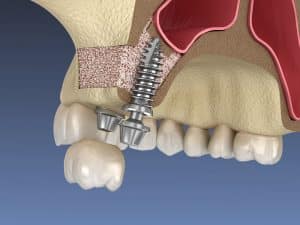 foto de elevaci&oacute;n seno maxilar injerto hueso para implantes dentales