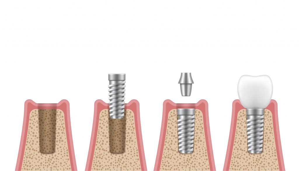 foto colocación implantes dental