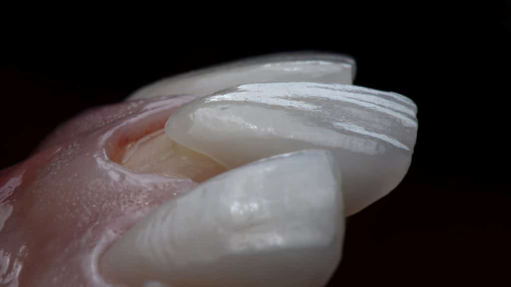 diseño digital de sonrisa para carillas dentales