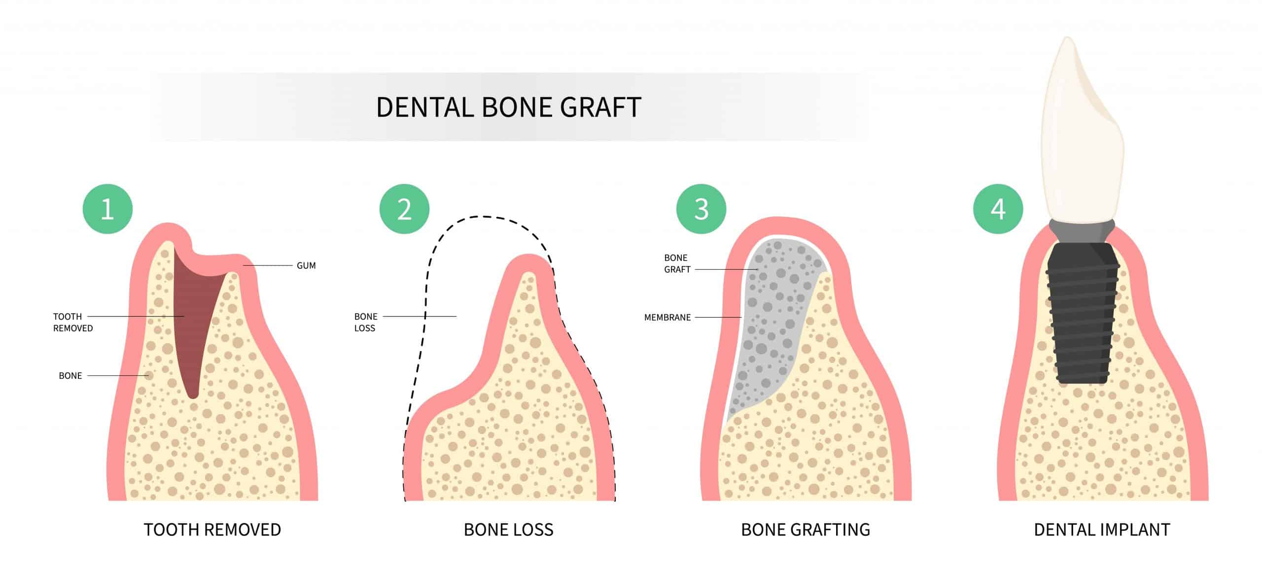 Foto del proceso de regeneración ósea guiada tras extracción para implante dental