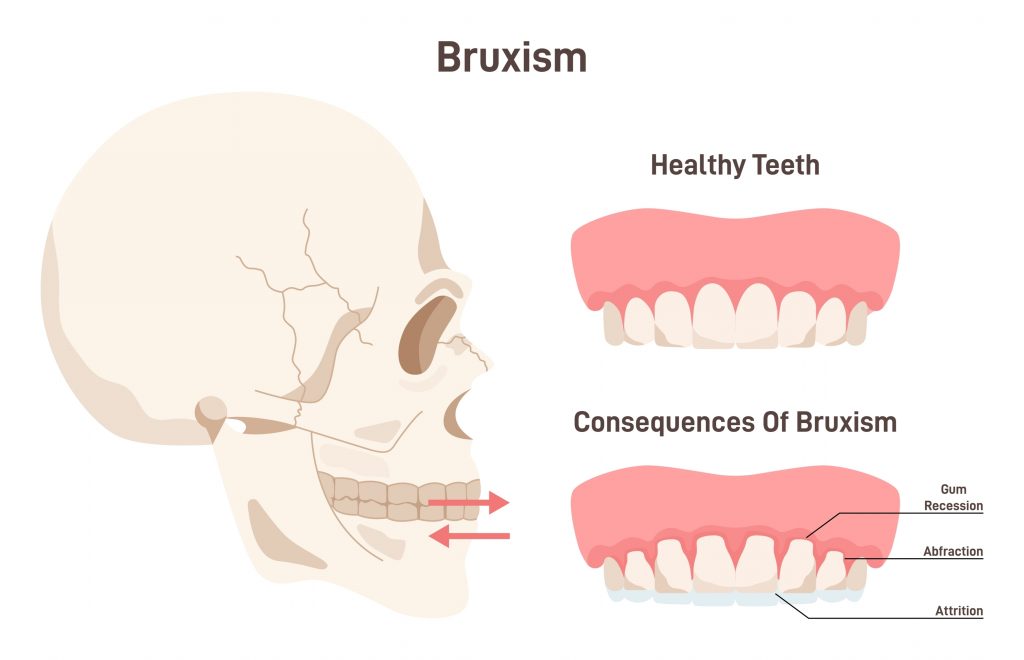 foto explicativa de que es el bruxismo