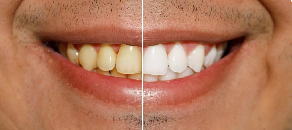 Caso antes y después blanqueamiento dental en clínica