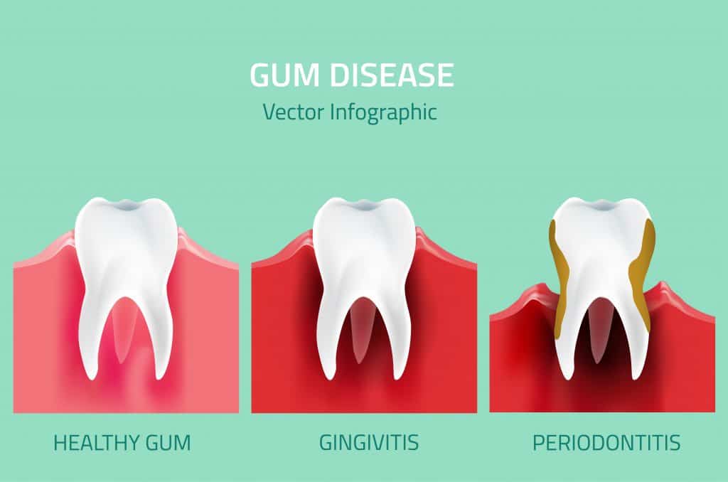 encías retraídas por periodontitis y gingivitis