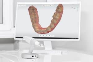 Foto de scanner 3D oral