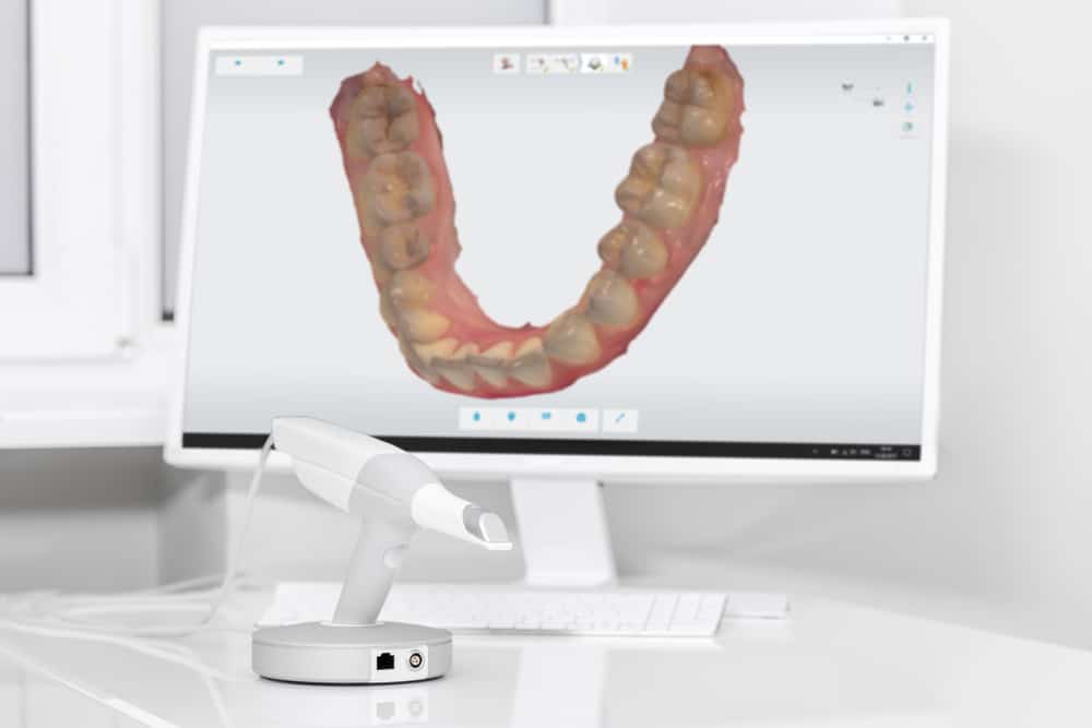 Foto de scanner 3D oral