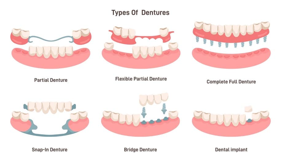 Tipos de prótesis dentales sobre implantes