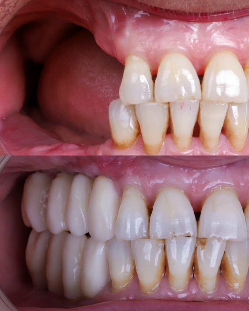 antes y después implantes dentales sin hueso dental